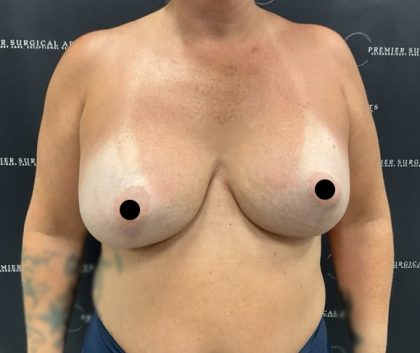 Breast Augmentation + Lift Before & After Patient #2558