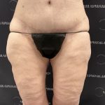Thigh Lift with Liposuction Before & After Patient #2539