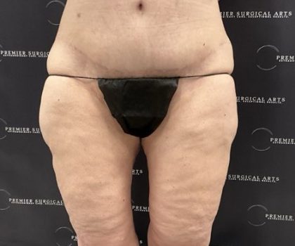 Thigh Lift with Liposuction Before & After Patient #2539