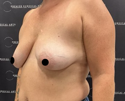 Breast Augmentation + Lift Before & After Patient #2558
