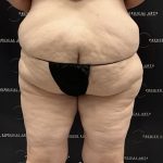 Thigh Lift with Liposuction Before & After Patient #2539