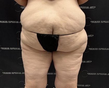 Thigh Lift with Liposuction Before & After Patient #2539