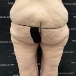 Thigh Lift with Liposuction Before & After Patient #2539