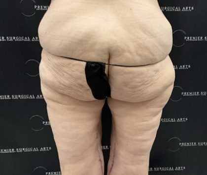 Thigh Lift with Liposuction Before & After Patient #2539