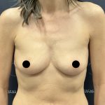 Breast Augmentation Before & After Patient #2559