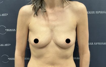 Breast Augmentation Before & After Patient #2559