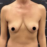 Breast Augmentation + Lift Before & After Patient #2568