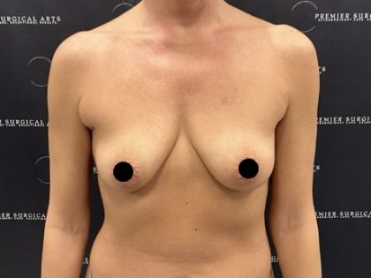 Breast Augmentation + Lift Before & After Patient #2568