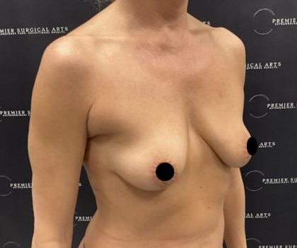 Breast Augmentation + Lift Before & After Patient #2568