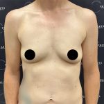Breast Augmentation Before & After Patient #2552