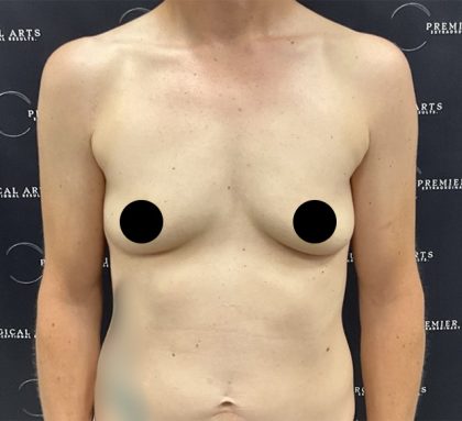 Breast Augmentation Before & After Patient #2552