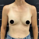 Breast Augmentation Before & After Patient #2552