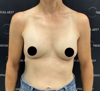 Breast Augmentation Before & After Patient #2552