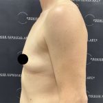 Breast Augmentation Before & After Patient #2552