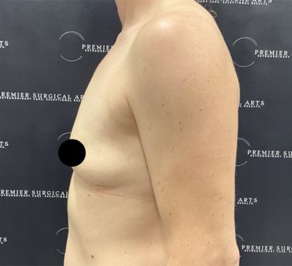 Breast Augmentation Before & After Patient #2552
