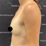 Breast Augmentation Before & After Patient #2552