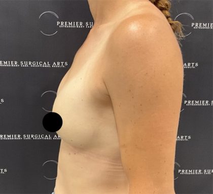 Breast Augmentation Before & After Patient #2552