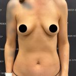 Mini Tummy Tuck Before & After Patient #2576