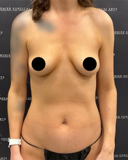 Mini Tummy Tuck Before & After Patient #2576