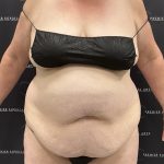 Lipo 360 Before & After Patient #2545