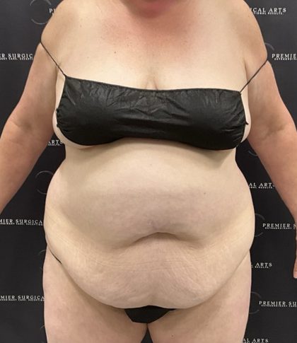 Lipo 360 Before & After Patient #2545
