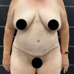 Lipo 360 Before & After Patient #2545