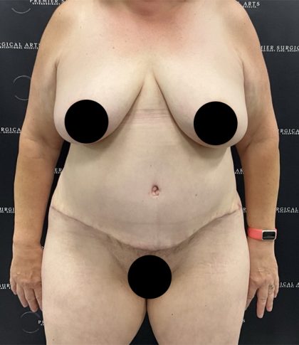 Lipo 360 Before & After Patient #2545
