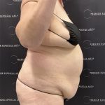Lipo 360 Before & After Patient #2545