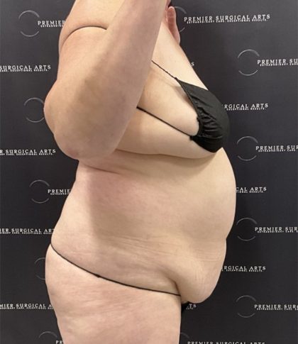 Lipo 360 Before & After Patient #2545