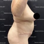 Lipo 360 Before & After Patient #2545