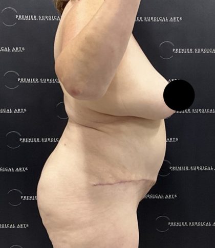 Lipo 360 Before & After Patient #2545