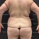Lipo 360 Before & After Patient #2545
