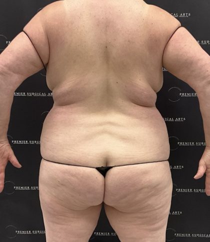 Lipo 360 Before & After Patient #2545