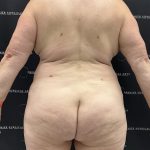 Lipo 360 Before & After Patient #2545