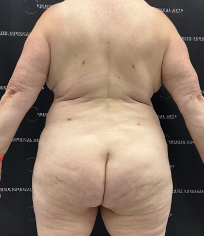 Lipo 360 Before & After Patient #2545