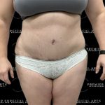 Lipo 360 Before & After Patient #2527
