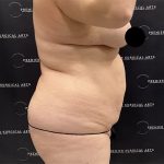 Lipo 360 Before & After Patient #2527
