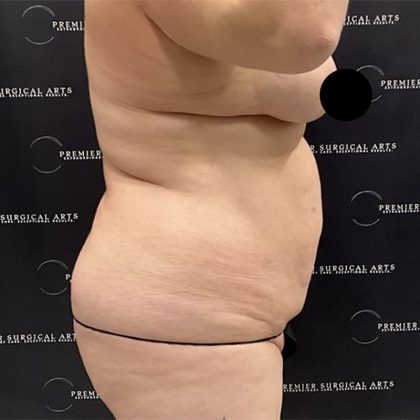 Lipo 360 Before & After Patient #2527