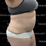 Lipo 360 Before & After Patient #2527