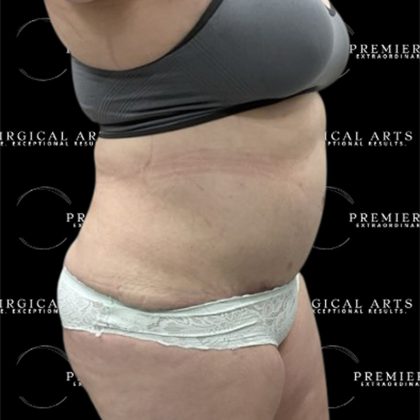 Lipo 360 Before & After Patient #2527