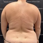 Lipo 360 Before & After Patient #2527
