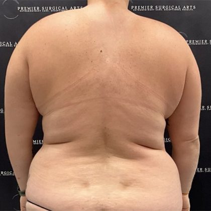 Lipo 360 Before & After Patient #2527