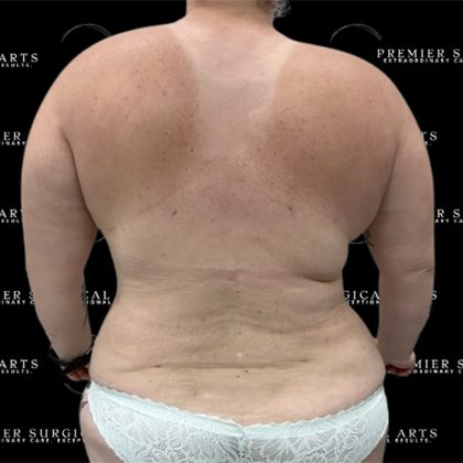 Lipo 360 Before & After Patient #2527