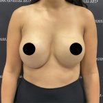 Breast Implant Exchange Before & After Patient #2624