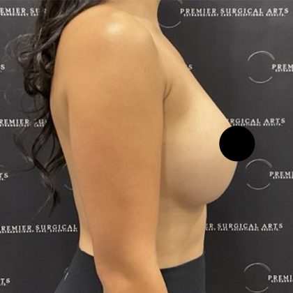 Breast Implant Exchange Before & After Patient #2624
