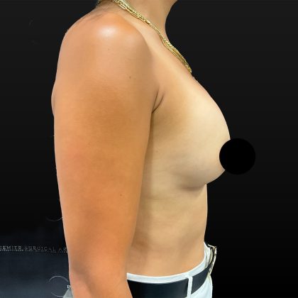 Breast Implant Exchange Before & After Patient #2624
