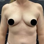 Breast Augmentation Before & After Patient #2601