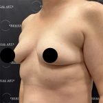 Breast Augmentation Before & After Patient #2601