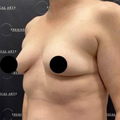 Breast Augmentation Before & After Patient #2601