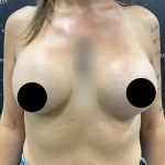 Breast Augmentation Before & After Patient #2587